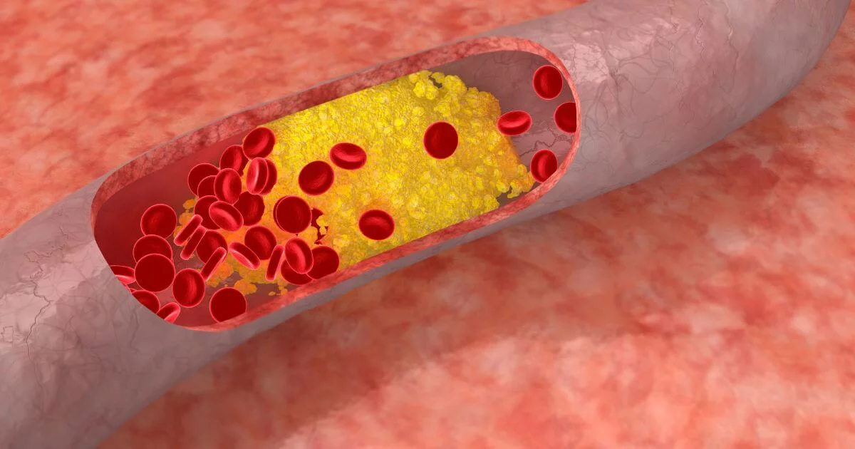 Verstopfte Arterie mit Cholesterinablagerungen und roten Blutkörperchen