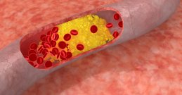 Verstopfte Arterie mit Cholesterinablagerungen und roten Blutkörperchen