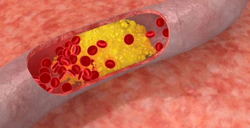 Verstopfte Arterie mit Cholesterinablagerungen und roten Blutkörperchen
